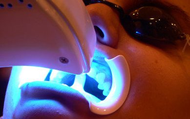 8 faktov o profesionálnom bielení zubov