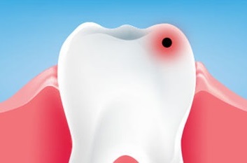 Najčastejšie ochorenia zubov