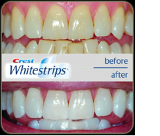 Výsledky bielenia zubov s pásikmi Crest. Bieliaci efekt je výrazne viditeľný. 