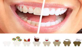 Určité typy potravín spôsobujú zafarbovanie zubov. Bielou diétou predídete sfarbovaniu zubov a biely úsmev vám vydrží dlhšie.