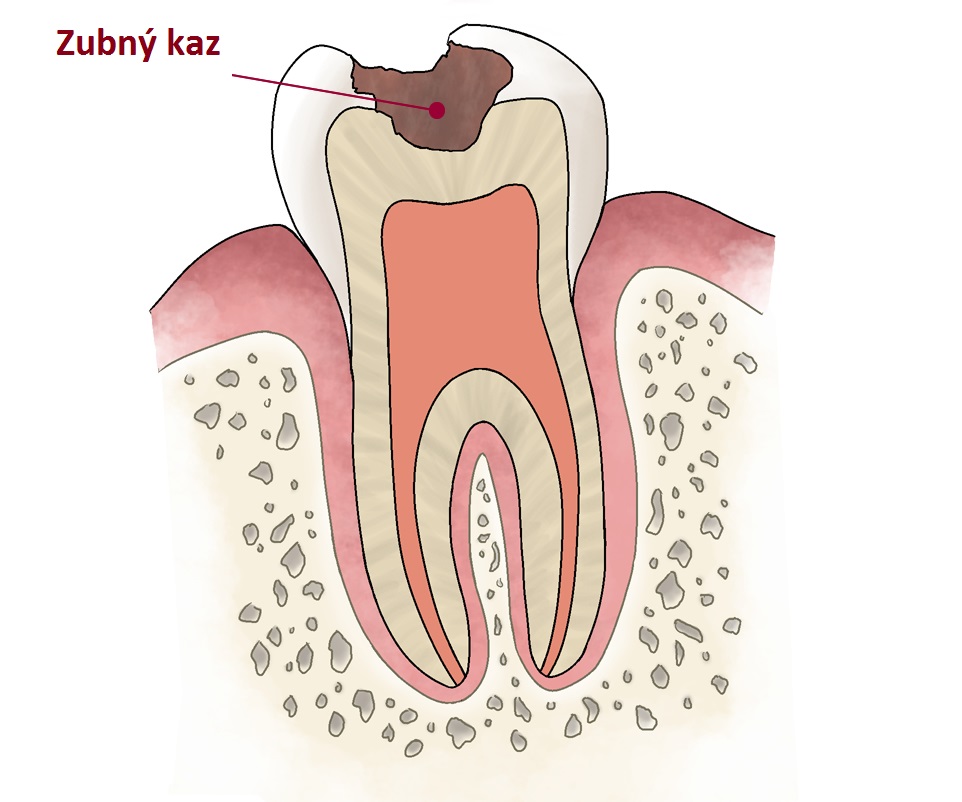 Zubný kaz je jednou z najčastejších civilizačných chorôb a postihuje až 95% osôb.